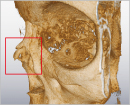 Nosal bone fracture (VR)